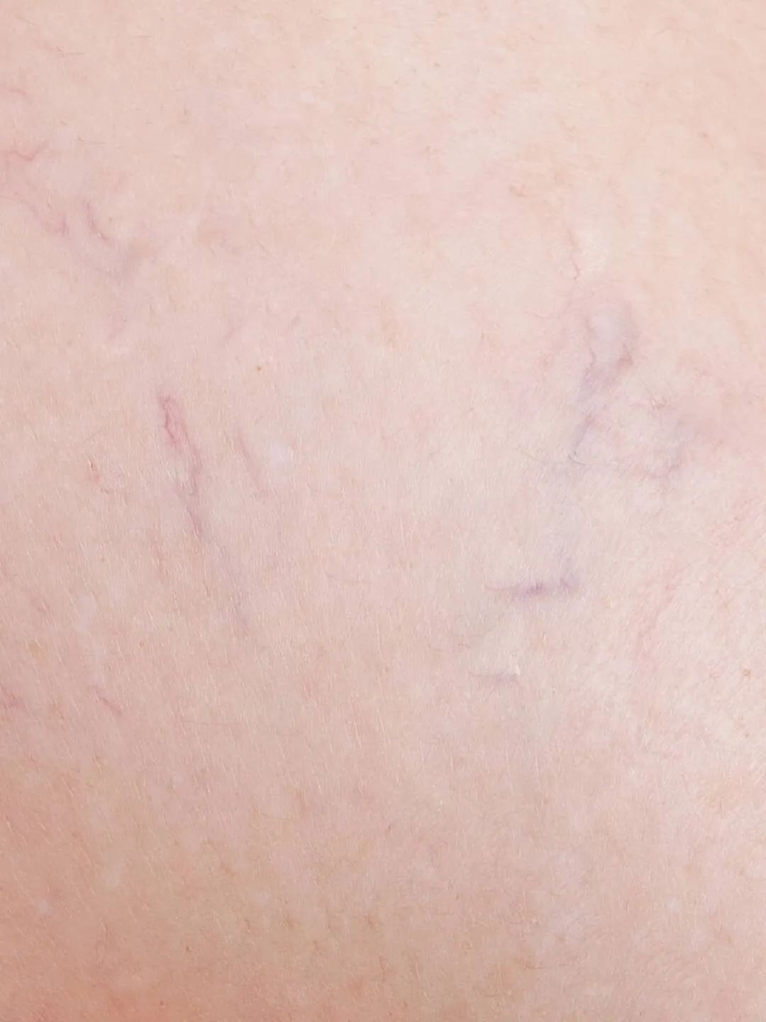 cellulite_edematosa_dibimilano