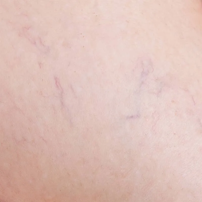 Cellulite edematosa