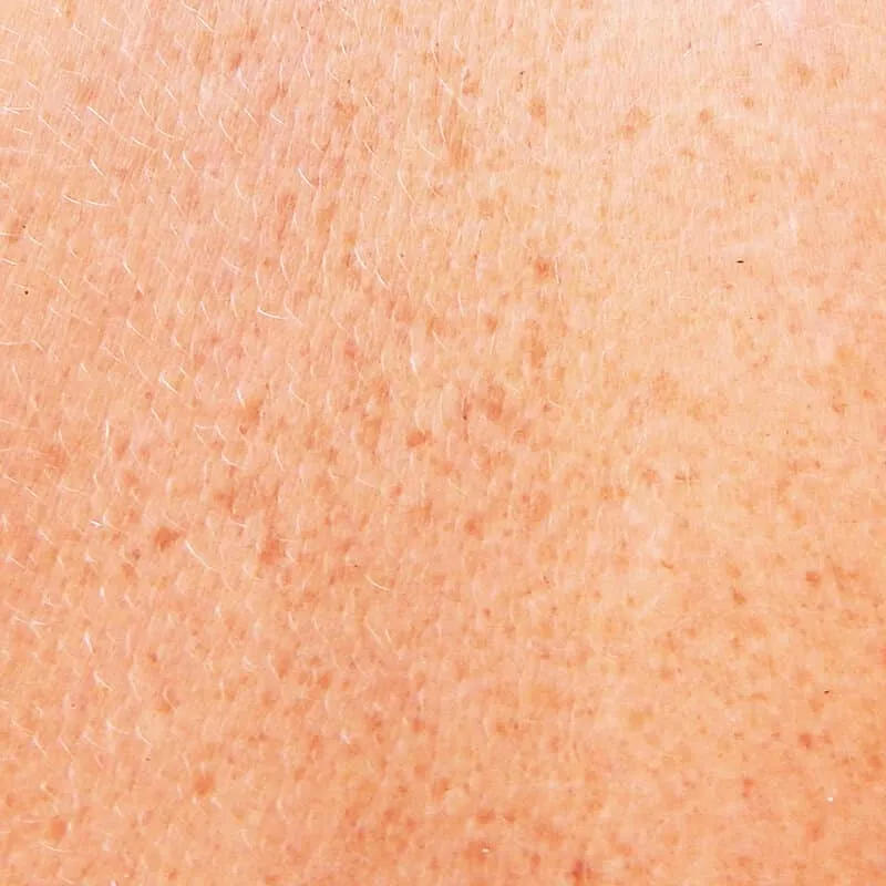 Skin with dyschromias