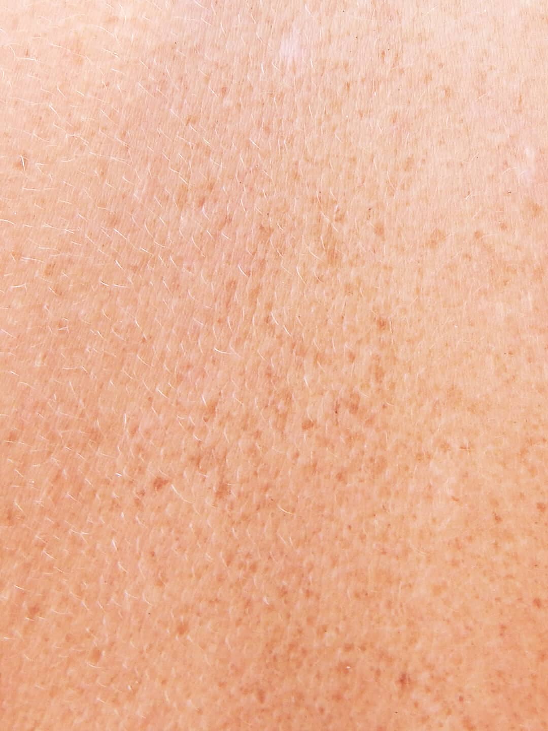 discromie_dibimilano